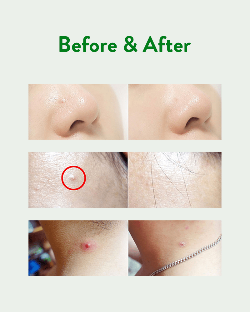 Acropass Trouble Cure Pimple Patch Before & After Photos